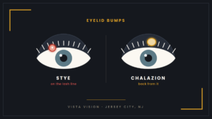 An infographic showing the difference between a chalazion and stye, illustration