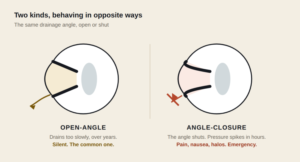 Cross-sections comparing open-angle glaucoma, where fluid drains too slowly over years, with angle-closure glaucoma, where the drainage angle shuts and pressure spikes in hours